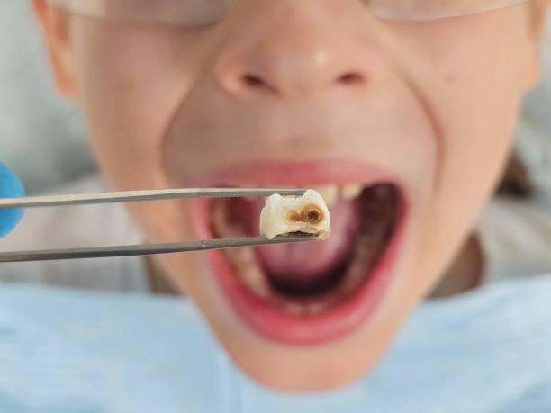 Best Emergency Treatment for Oral Infections in Gridley, IL